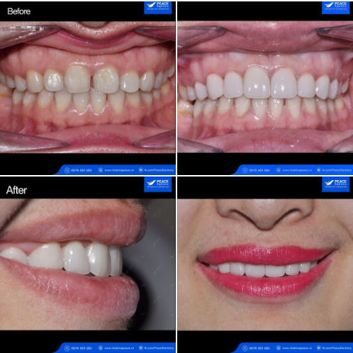 Ca lâm sàng: thiết kế lại nụ cười với chi phí tiết kiệm và giữ lại tối đa răng thật