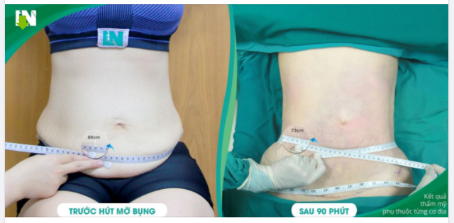 Cập nhật tình trạng vùng bụng sau 2h Hút mỡ tạo dáng thẩm mỹ​​​​​​​ của Chị Khách hàng (27 tuổi – đã sinh 1 bé) trước đó: da bụng bị chảy xệ nặng.