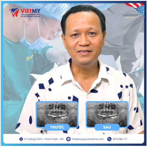 Case trồng răng implant cho chú Đức tại Nha khoa quốc tế Việt Mỹ