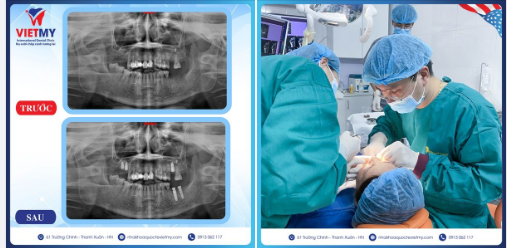 Case trồng răng Implant cho khách hàng Mai Hương đến từ Ba Đình- Hà Nội