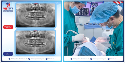 Case trồng răng Implant cho khách hàng Thu Trang đến từ Thanh Xuân - Hà Nội