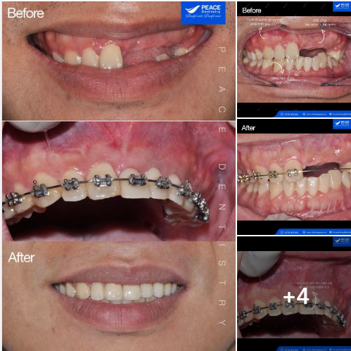 Chỉnh nha 2 hàm (mắc cài kim loại) với các mục tiêu: đánh lún răng để khắc phục tình trạng cười hở nướu, chỉnh cho răng đều đặn và đặc biệt là tạo khoảng phục vụ cho việc cấy ghép Implant hiệu quả n