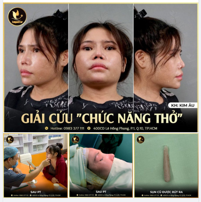 CÓ ĐƯỢC BAO NHIÊU % ĐỂ EM THỞ ĐƯỢC VẬY BÁC SĨ ƠI?