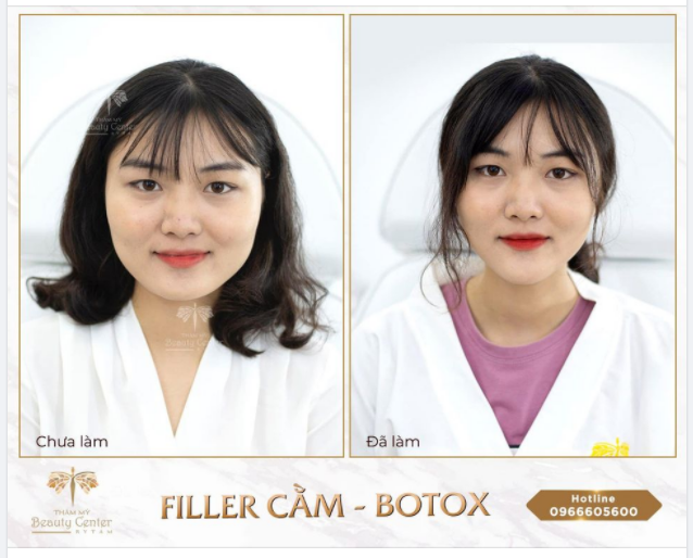 Combo thần thánh: Botox thon gọn hàm - Filler cằm đã giúp khách hàng của trung tâm thay đổi như thế nào?