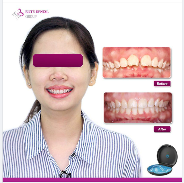 ​​​​​​​Điều trị “combo” hô - cắn sâu - cắn chìa - thưa răng cửa hiệu quả với Invisalign tại Elite Dental