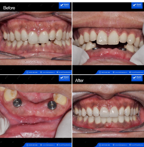 Khách hàng có 4 răng cửa hàm dưới (R31-42) gãy chỉ còn chân răng và cũng lung lay; răng R33 vỡ một phần răng có viêm tủy.