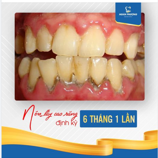 Lấy cao răng là một trong những phương pháp làm sạch răng miệng.