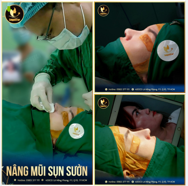 NÂNG MŨI SỤN SƯỜN CÓ LÀ PHƯƠNG PHÁP TỐI ƯU NHẤT SỬA CHỮA NHỮNG CHIẾC MŨI HỎNG?