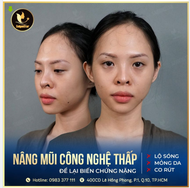 SAU 10 NĂM NÂNG MŨI – CÔ GÁI XINH ĐẸP NHẬN LẠI CHIẾC MŨI HỎNG