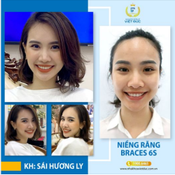 Thẩm mỹ răng đi đôi với đảm bảo sức khỏe răng miệng là tiêu chí hàng đầu của Chị Sái Hương Ly – Top 10 Hoa Hậu Việt Nam