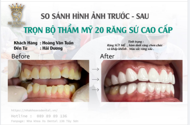 Thay đổi hoàn toàn hàm răng và diện mạo nhờ thẩm mỹ trọn bộ 20 răng sứ cao cấp CERAMIL .