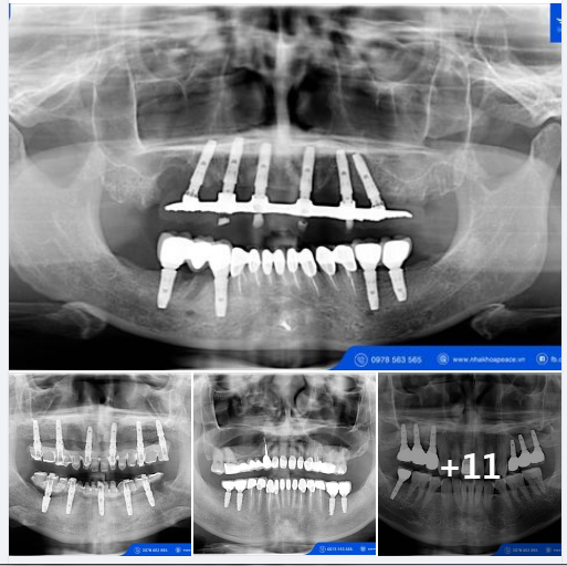 Thông thường khi nói đến trồng răng Implant, chúng ta đều nghĩ sau khi cấy ghép trụ Implant sẽ phải chờ vài tháng rồi mới cố định răng sứ.