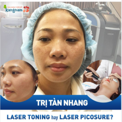 Tình trạng tàn nhang của bạn nên điều trị công nghệ Laser nào?