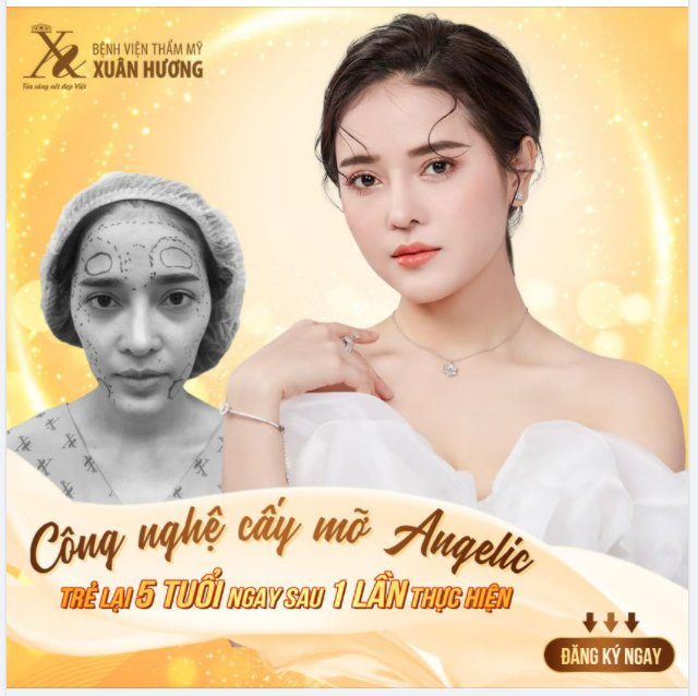 TRẺ HÓA TOÀN DIỆN KHUÔN MẶT CHỈ SAU 1 LẦN THỰC HIỆN CẤY MỠ TỰ THÂN ANGELIC ĐỘC QUYỀN tại BVTM Xuân Hương.
