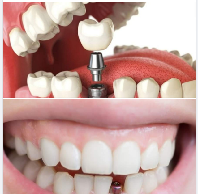 Trồng Implant Giải Pháp Tối Ưu Khi Bị Mất Răng