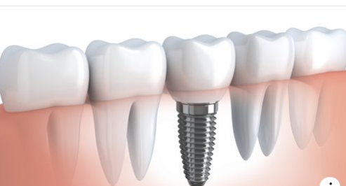 ​​​​​​​Trụ Implant vẫn có thể bị đào thải sau khi một thời gian phục hình.