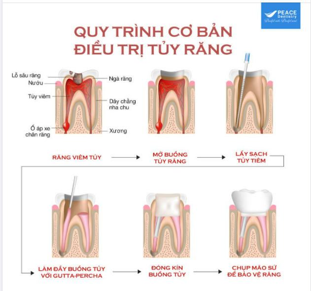 Viêm tủy răng – Những điều bạn cần biết!