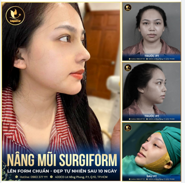 10 NGÀY HÓA NGỌC NỮ SAU NÂNG MŨI - ĐỘN CẰM