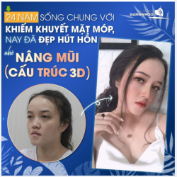 24 NĂM SỐNG CHUNG VỚI KHUYẾT ĐIỂM MẶT MÓP, CHỊ KHÁCH HÀNG NAY ĐÃ ĐẸP HÚT HỒN