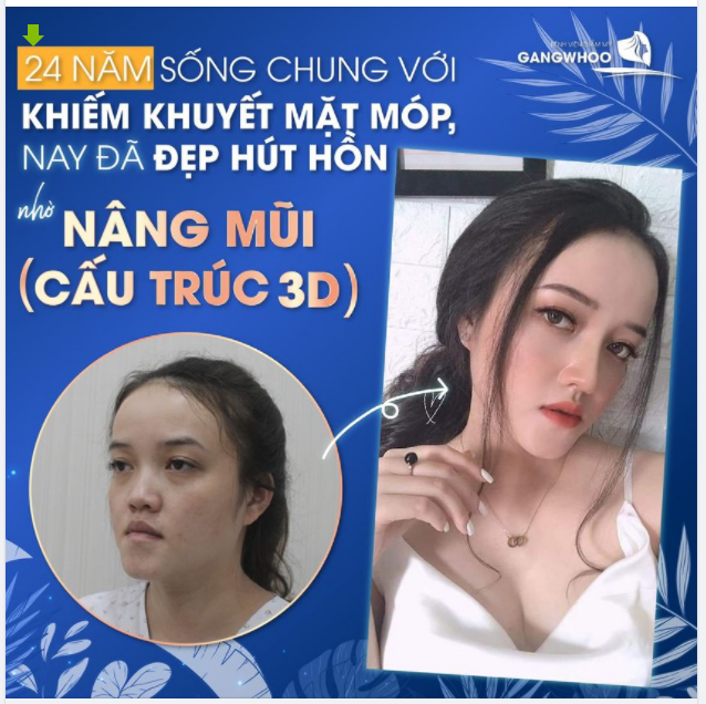 24 NĂM SỐNG CHUNG VỚI KHUYẾT ĐIỂM MẶT MÓP, CHỊ KHÁCH HÀNG NAY ĐÃ ĐẸP HÚT HỒN