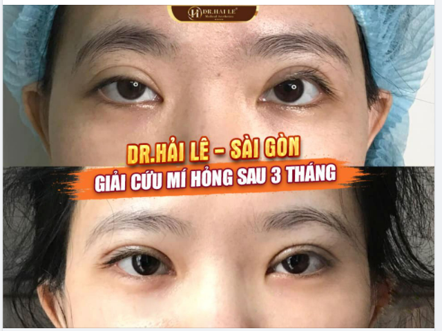 3 tháng trước bạn ấy đến gặp bác sĩ để sửa lại mí Và 3 tháng sau nhắn tin khoe kết quả