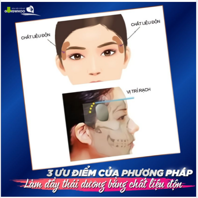 3 ƯU ĐIỂM CỦA PHƯƠNG PHÁP LÀM ĐẨY THÁI DƯƠNG BẰNG CHẤT LIỆU ĐỘN