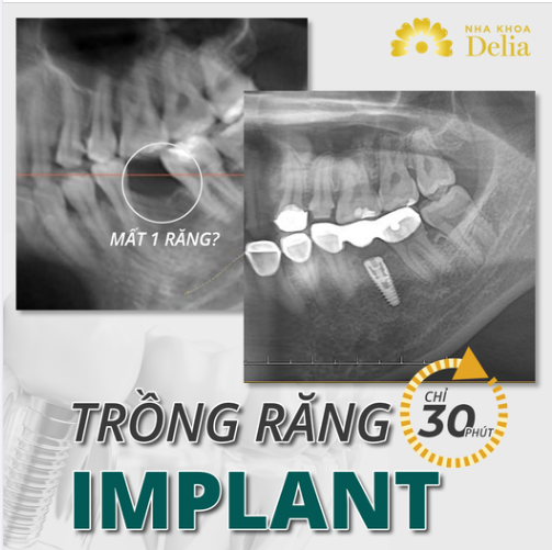 30 PHÚT CHO 01 CHÂN RĂNG IMPLANT MỚI!