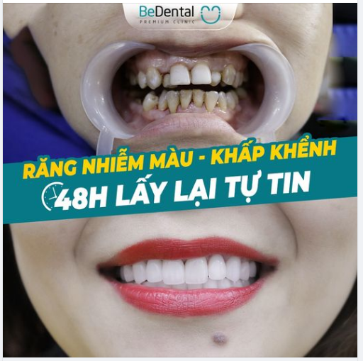 48 NĂM ngại ngùng vì hàm răng khấp khểnh, nhiễm màu kháng sinh, ăn nhai ê buốt vì men răng càng ngày càng yếu
