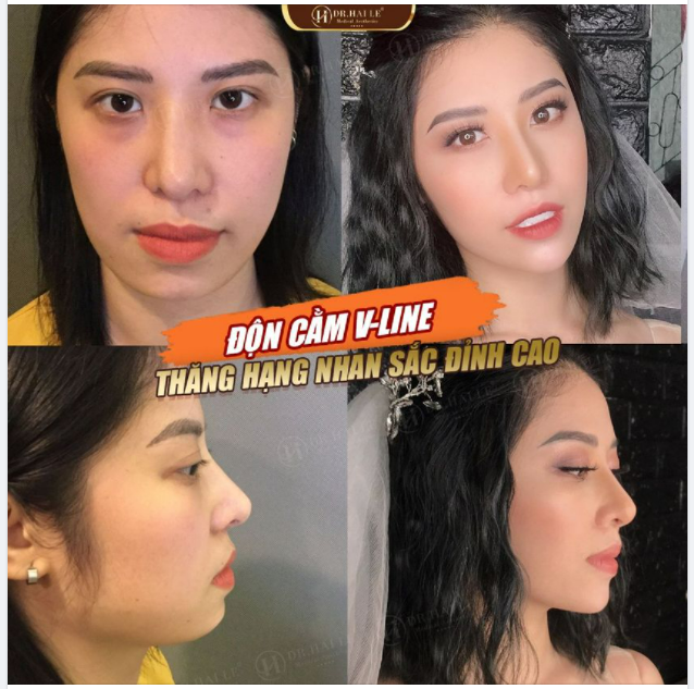 5 LƯU Ý CHĂM SÓC SAU PHẪU THUẬT ĐỘN CẰM. CẦN GHI NHỚ!