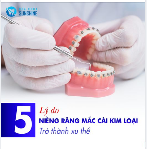 5 LÝ DO NIỀNG RĂNG MẮC CÀI KIM LOẠI THÔNG MINH TRỞ THÀNH XU THẾ CHÍNH HIỆN NAY