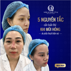 5 nguyên tắc cần tuân thủ khi nâng mũi hỏng do phẫu thuật thẩm mỹ