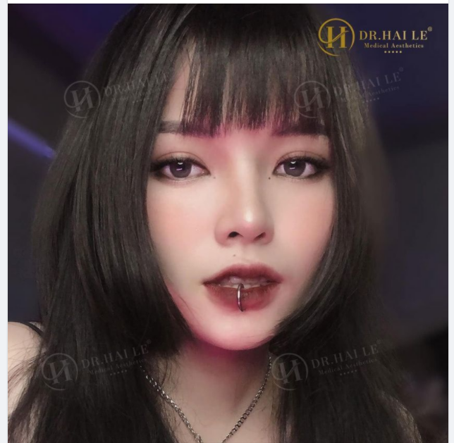5 phút trước có KH hỏi Cắt mí tại Dr.Hải Lê sau 3 năm trông sẽ như thế nào, mí còn đẹp nữa không?