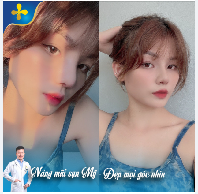 5 SUẤT MỖI NGÀY CHO 5 KHÁCH HÀNG ĐẦU TIÊN NÂNG MŨI SỤN MỸ CHỈ TỪ 18 TRIỆU