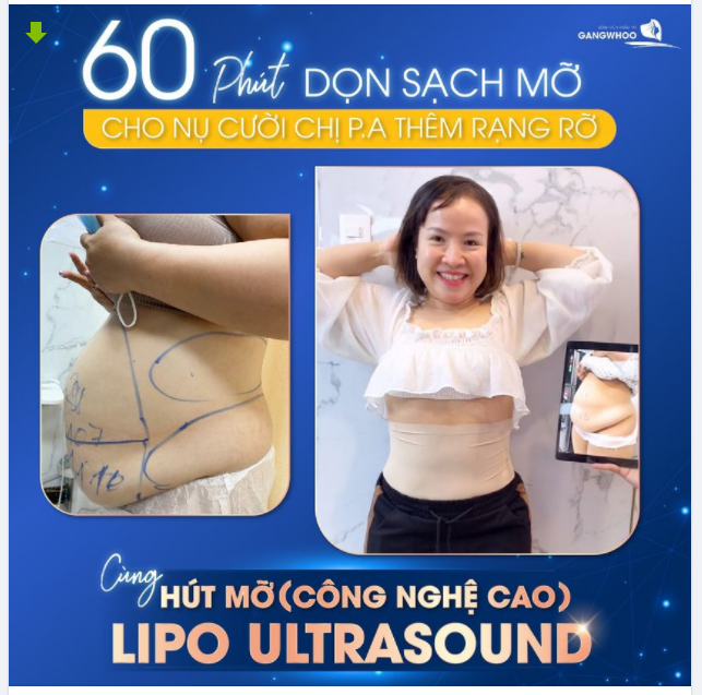 60 PHÚT DỌN SẠCH MỠ - CHO NỤ CƯỜI CHỊ P.A THÊM RẠNG RỠ CÙNG LIPO ULTRASOUND