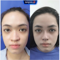 75 phút - Khoe ngay dáng mũi THON CAO của ca Nâng mũi đầu tiên ngày đầu tuần