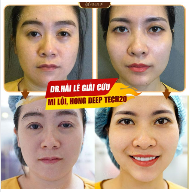 8 ĐIỂM CỘNG TẠO NÊN SỰ ĐẶC BIỆT CỦA SỬA MÍ DEEP TECH 20 TẠI DR.HẢI LÊ