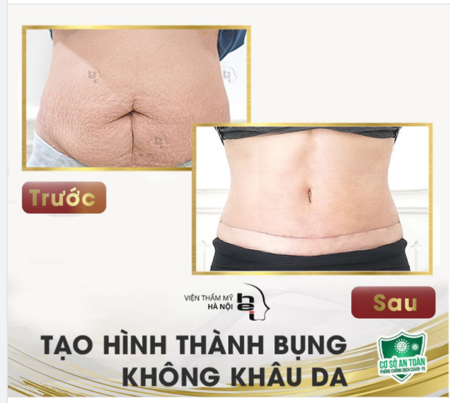 90p tạo hình - Vòng bụng THON GỌN XUẤT SẮC