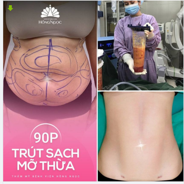 90P TRÚT SẠCH MỠ THỪA Không cần luyện tập Không cần ăn kiêng