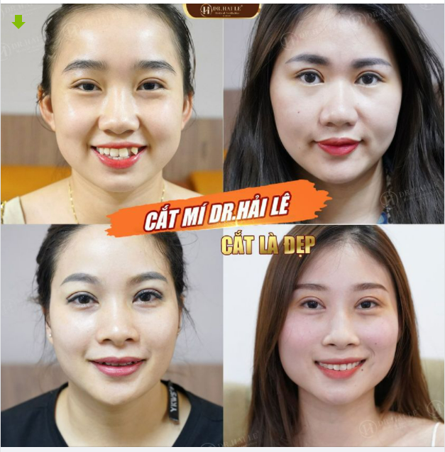 99% khách hàng của Dr.Hải Lê lo lắng trước khi Cắt mí