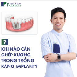 AI CẦN GHÉP XƯƠNG Ổ RĂNG KHI TRỒNG RĂNG IMPLANT