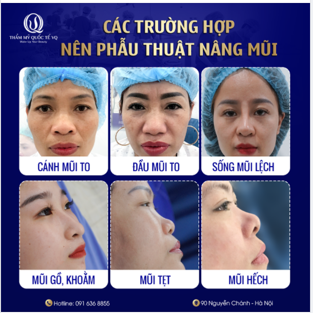 AI ĐANG GẶP PHẢI CÁC TRƯỜNG HỢP MŨI NÀY THÌ LIÊN HỆ BS VŨ QUANG GẤP