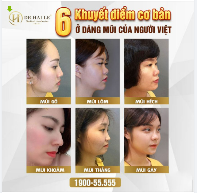 AI ĐANG GẶP PHẢI CÁC TRƯỜNG HỢP MŨI NÀY THÌ LIÊN HỆ DR.HẢI LÊ GẤP