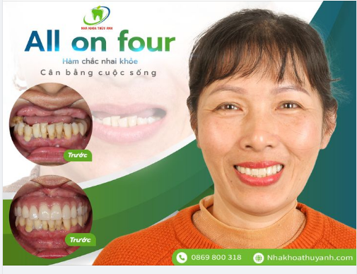ALL ON 4 IMPLANT ĐÃ THAY ĐỔI NỤ CƯỜI NHƯ THẾ NÀO?