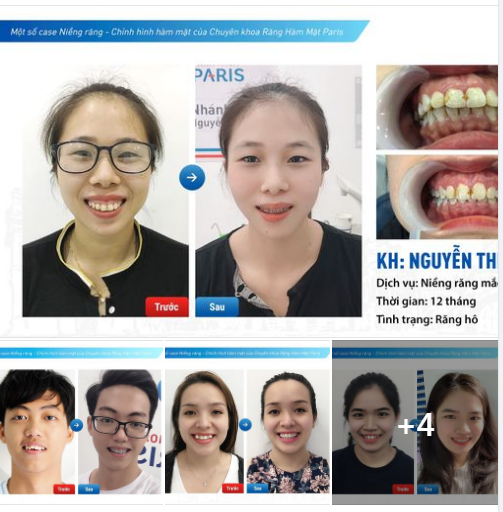 "Ăn đu đủ", "nạo dừa" là những cụm từ khiếm nhã dành cho những người không may mắn gặp phải tình trạng răng hô.