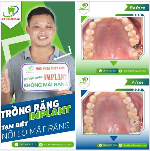 ĂN NHAI CẢ THẾ GIỚI CÙNG VỚI RĂNG IMPLANT