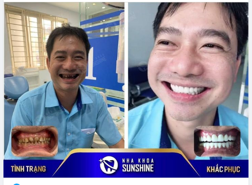 Anh khách đến với Nha khoa Sunshine với nỗi lo lắng hàm răng bị ố vàng, sỉn màu, mòn khớp cắn nhưng khi ra về là hàm răng trắng sáng, rạng rỡ nụ cười.