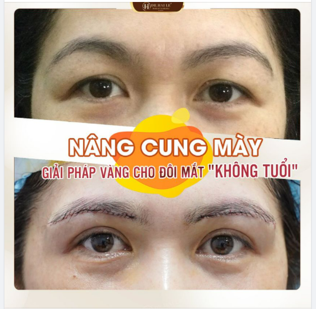 Ảnh thật, kết quả thật - Khách hàng tự tin ngay sau khi Nâng cung mày tại Dr.Hải Lê.