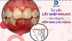 BÁC SĨ CHUYÊN KHOA IMPLANT TƯ VẤN: CẤY GHÉP RĂNG IMPLANT CHO RĂNG BỊ VIÊM NHA CHU NẶNG