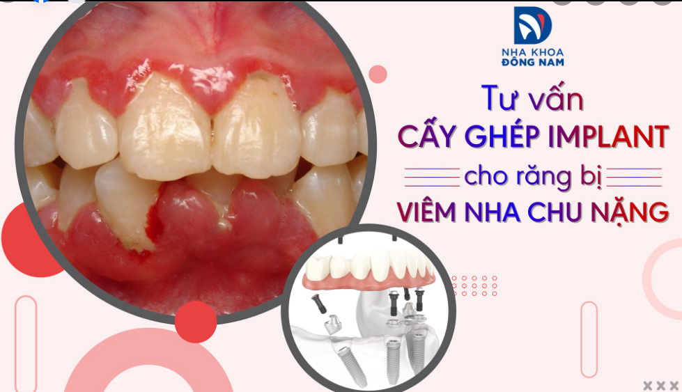 BÁC SĨ CHUYÊN KHOA IMPLANT TƯ VẤN: CẤY GHÉP RĂNG IMPLANT CHO RĂNG BỊ VIÊM NHA CHU NẶNG