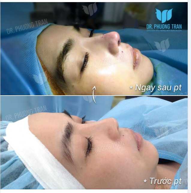 BẠN ẤY ĐÃ KHÔNG NHẬN RA CHÍNH MÌNH NGAY SAU NÂNG MŨI
